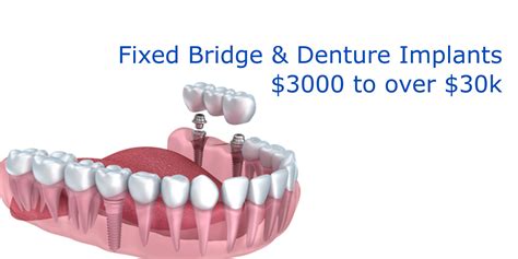 multiple dental implants cost